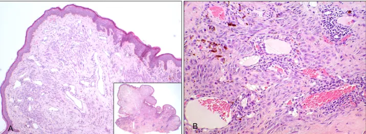 Fig.  2.  There  was  epidermal  thinning  with  a  partial  epidermal  collarette  and  tumor  cells  involving  the  full  thickness  of  the  dermis  without  epidermal  involvement  (A-inset)  (H&amp;E,  original  magnification × 10)