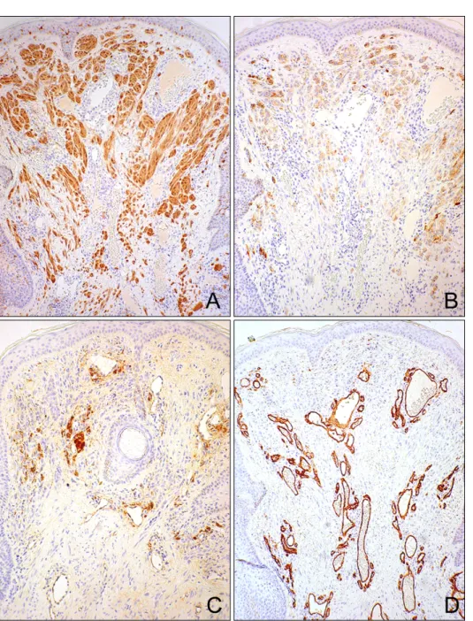 Fig.  3.  Immunostaining  for  S-100  protein  showed  a  positive  reaction  within  the  nevus  cells  (A),  HMB-45  staining  was  partially   posi-tive  within  upper  dermal  nests  (B),  Factor  VIII  and  CD34  was  positive  within  blood  vessels,