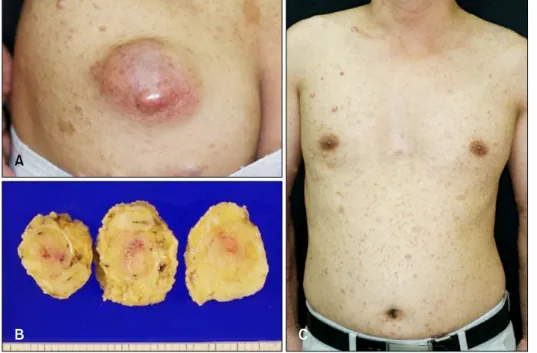 Table  1.  Summary  of  the  reported  cases  of  malignant  peripheral  nerve  sheath  tumor  in  Korean  dermatologic  literature No