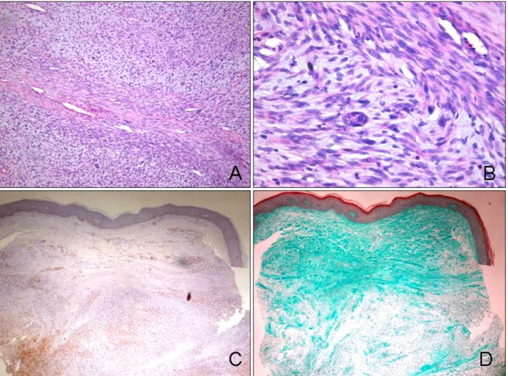 Fig.  2.  The  biopsy  specimen  showed  a  large  mass  in  the  dermis,  showing  a  dense  cellularity  of  spindle  cells  in  a  fascicular  pattern  (A:  H&amp;E,  × 100)
