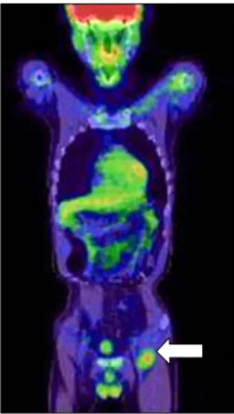 Fig.  3.  PET-CT  of  the  whole  body  showed  an  increase  in  FDG  uptake  in  the  left  inguinal  region  (arrow),  findings  suggestive  of  lymph  node  metastasis,  which  was  confirmed  with  biopsy.
