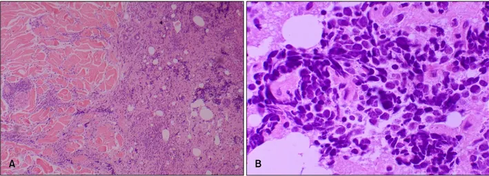 Fig.  2.  The  tumor  cells  with  anastomosing  and  interdissecting  trabecular  arrangement  in  the  dermis  (A:  H&amp;E, 