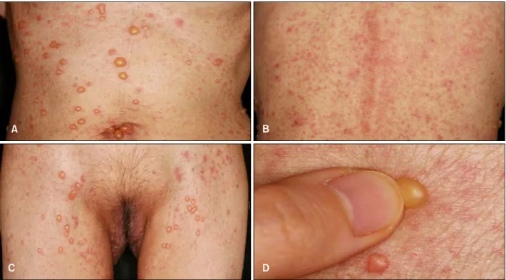 Fig.  1.  Pruritic,  multiple,  tense  vesicles  and  confluent  erythematous  papules  and  plaques  on  the  trunk  (A,  B),  inguinal  areas,  and  upper  thighs  (C)