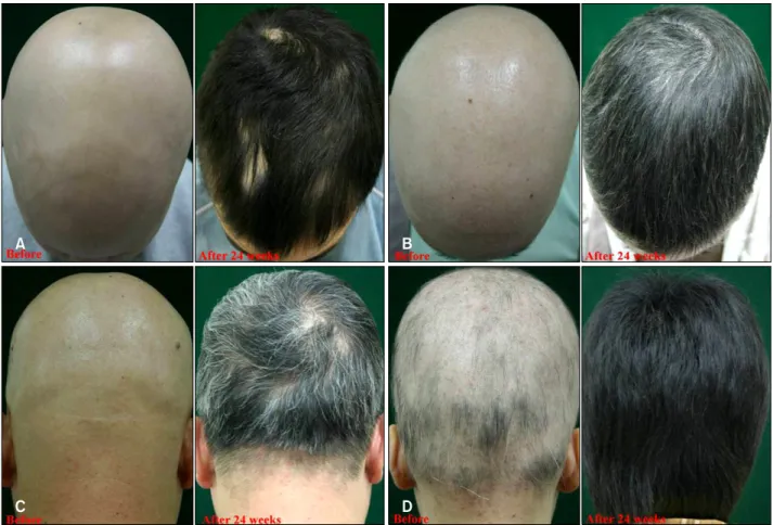 Fig.  1.  (A)  A  10-year-old  boy  with  alopecia  universalis  before  and  after  24  weeks  of  treatment