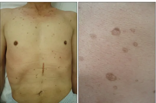 Fig.  1.  Numerous,  round  and  brownish  macules  and  patches  with  elevated  borders.
