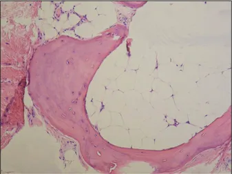 Fig.  2.  Nests  of  nevus  cells  were  seen  within  the  upper  dermis,  and  bony  spicules  surrounding  the  mature  fatty  tissue  were  observed  in  the  lower  dermis,  underneath  the  nevus  cell  nests  (Hematoxylin-eosin,  ×40).