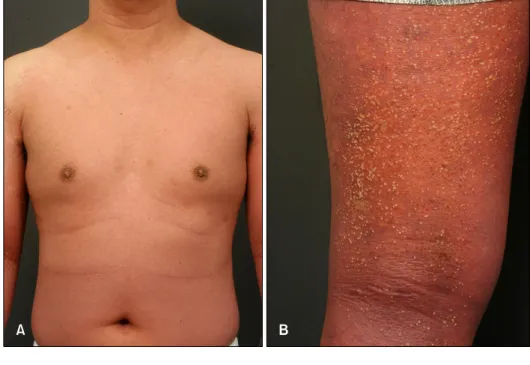 Fig.  1.  (A)  Generalized,  symmetrical  erythema  with  overlying  pustules  on  the  trunk