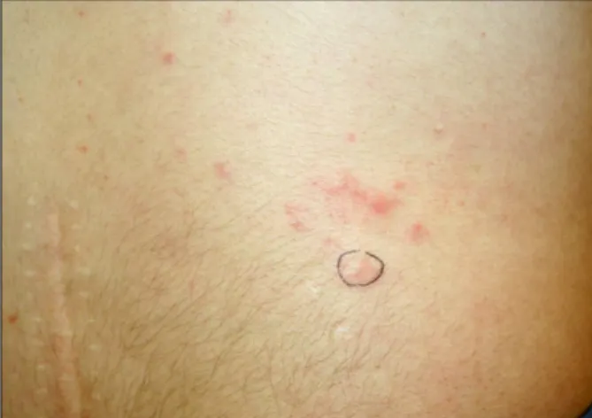 Fig.  1.  Multiple,  relatively  well-demarcated,  flesh  or  erythematous  colored  papules  on  the  lower  back.