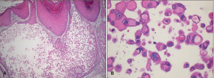 Fig.  3.  Positive  staining  for  cytokeratins  with  a  crisp  cytoplasmic  staining  pattern  (Pan-CK,  ×400,  Avidin-  biotin  complex  method).
