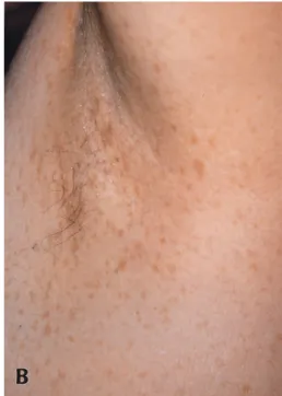 Fig. 1. (A) Multiple caf  au lait spots on the back. (B) Numerous freckles are noted on the left side of axilla.