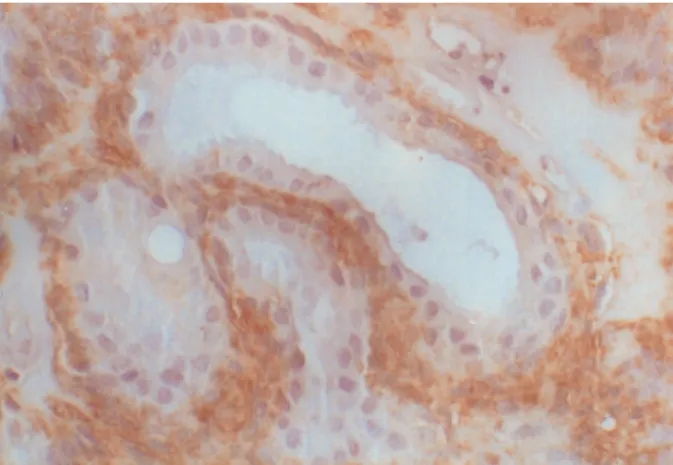 Fig. 6. S-100 protein was detected only in the periph- periph-eral  layer  of  the  tubular  structures  and  stroma  (S-100