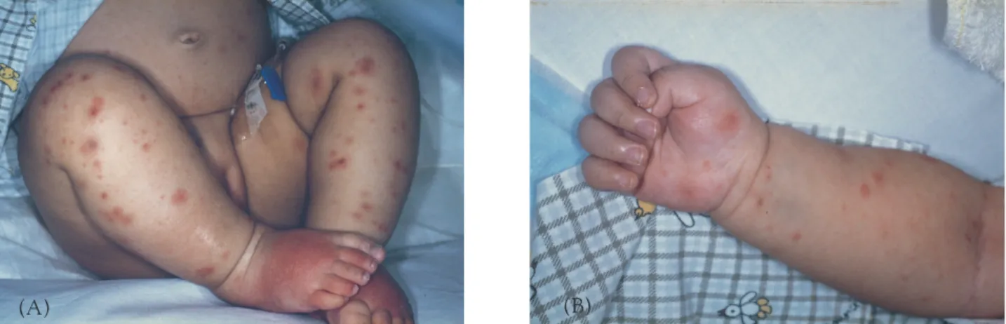 Fig. 2. A dense linearly distributed nodular neutrophilic inﬁltrate around eccrine sweat units extends to the  sub-cutis (H&amp;E,  × 40).