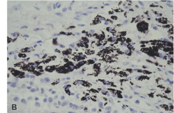 Fig. 4. Tumor cells are stained diffusely with NSE and chromogranin A (A: NSE, B: chromogranin A × 400).