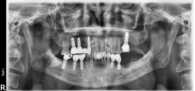 Fig. 2. Panoramic image of case 1 patient immediately after surgery. The defects were filled by graft  material well.