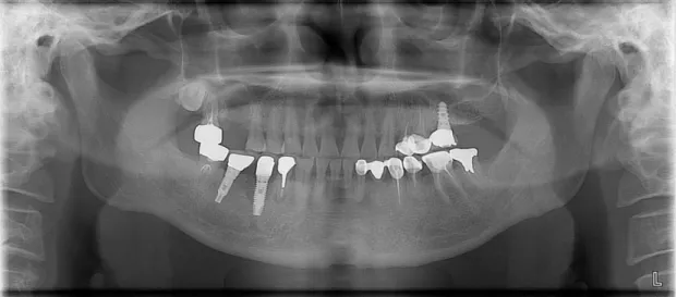 Fig. 5. First visit panoramic image of case 2 patient. There was a 7mm mesio-disto lingual intrabony  defect on #45 implant.