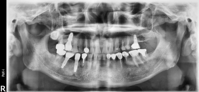 Fig. 7. After 3 years follow-up, panoramic image proved well remained bone fill. He lost a crown of 