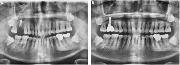 Fig. 1. (A) Panoramic radiograph revealed the fracture of abutment screw on the maxillary right first molar implant, (B) A  new prosthesis was applied.