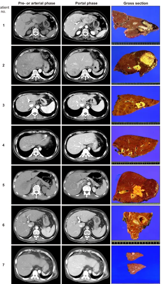 Fig. 1. Preoperative computed  tomography findings and gross  photographs of surgical  speci-mens obtained after initial  hepa-tectomy