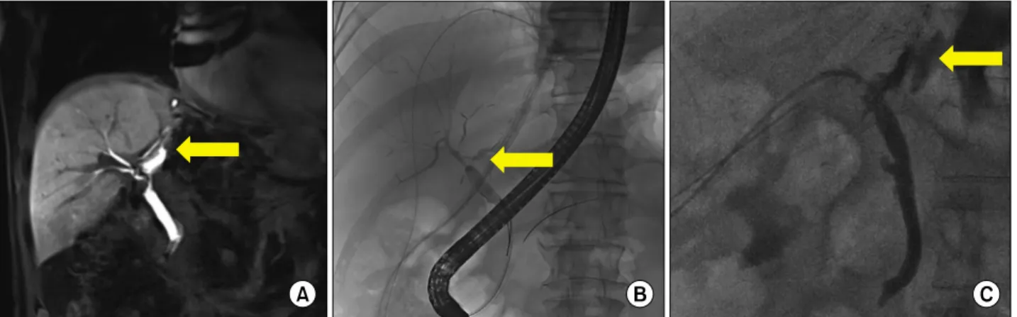 Fig. 1. (A) Gd-EOB DTPA 40 minute delay image in the case of biliary anastomosis leakage