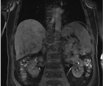 Fig. 3. Gd-EOB DTPA MRI findings of the case with cut sur-