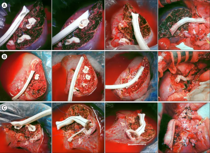 Fig. 1. Intraoperative photographs showing techniques for middle hepatic vein reconstruction using a Hemashield vascular graft