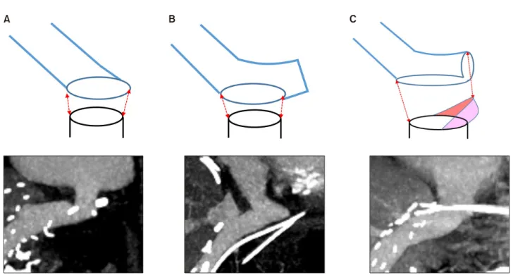 Fig. 2. Schematic illustration of reconstruction techniques for anastomosis of a Hemashield graft conduit to the recipient’s left-middle hepatic vein trunk stump