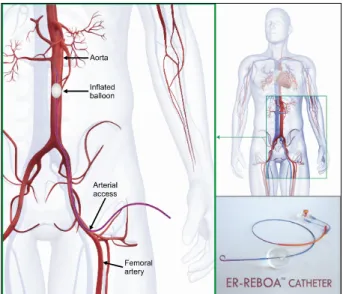 Fig. 1. REBOA catheter placement involves cannulation of  the common femoral artery, insertion of an introducer sheath  with Seldinger technique over a guidewire, and placement of  the device by either landmark or radiologic guidance into an  aortic zone