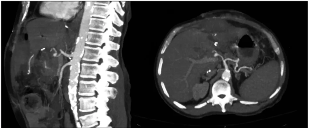 Fig. 2. Computed tomography  revealing a main HA  pseudoa-neurysm with active  extravasa-tion and an associated  hemope-ritoneum.