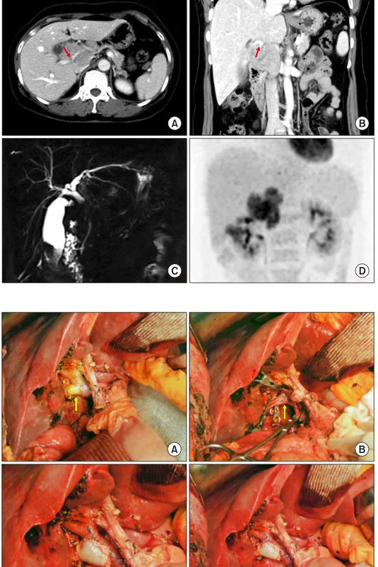 Fig. 2. Intraoperative photographs  of wedge resection of the hilar  portal vein (PV) invasion and  roof patch venoplasty in Case  No