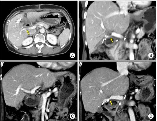 Fig. 3. Gross photographs of Case No. 1 specimen after ex- ex-tended cholecystectomy and bile duct resection showing  ad-enosquamous carcinoma of the gallbladder.