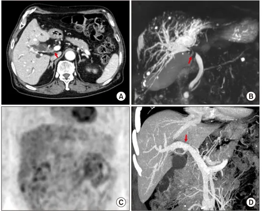 Fig. 5. Preoperative radiologic  findings of Case No. 2. (A)  Com-puted tomography scan shows  perihilar cholangiocarcinoma of  type I (arrow)