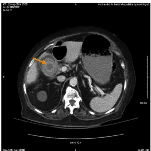 Fig. 1. Computed tomography images of an enlarging intra- intra-luminal gallstone. Axial view demonstrating interval  enlarge-ment of a gallstone within the gallbladder lumen