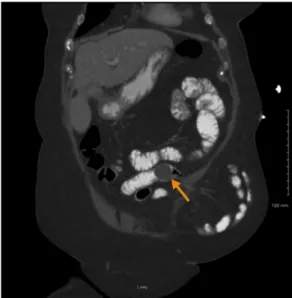 Fig. 3. Gross pathologic specimen from surgery. This image  demonstrates the gross pathology of a large gallstone  measur-ing 5 cm.