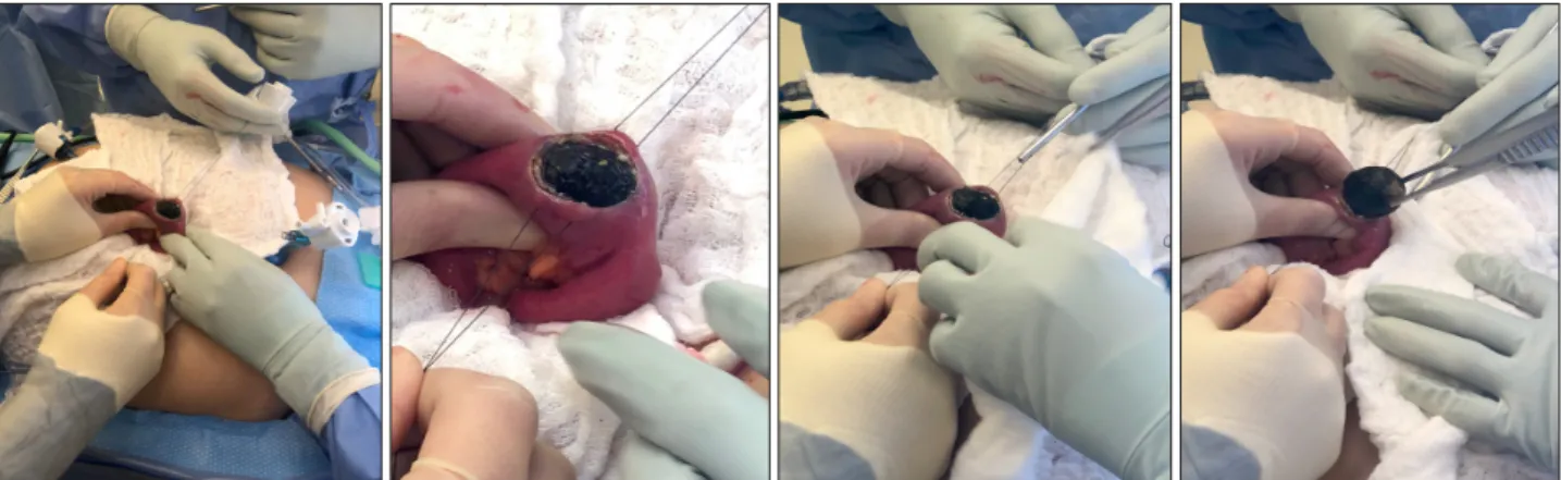 Fig. 4. Gross view of enterotomy created for stone extraction.
