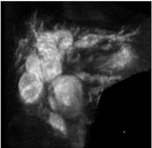 Fig. 3. Intraoperative Cholangiography. Bile duct dilatation co- co-municated with pseudocyst.