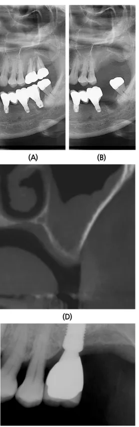 Fig. 1. (A) Panoramic view (first visit). (B) Panoramic view (after extraction of #26, 27)