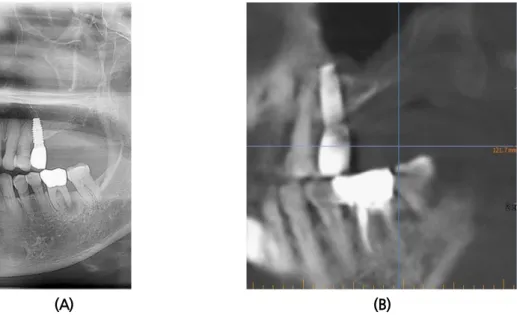 Fig.  2. (A) Panoramic view (first visit). (B) Pre-operative CT panoramic view. (C) Pre-operative CT  coronal view