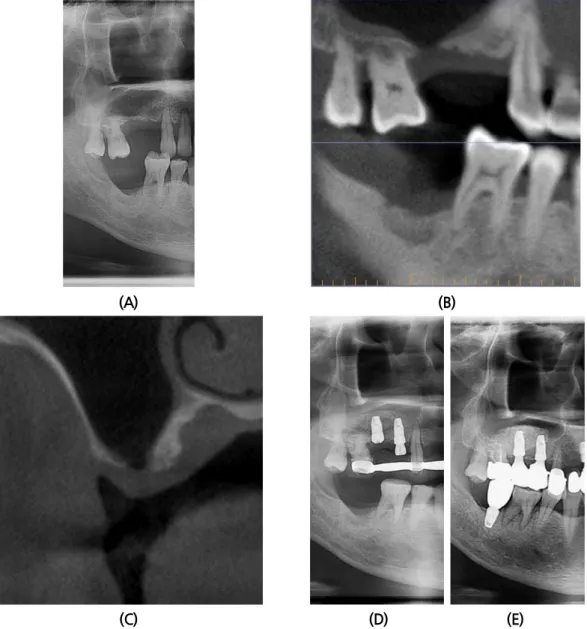 Fig.  3. (A) Panoramic view (first visit). (B) Pre-operative CT panoramic view. (C) Pre-operative CT  coronal view (#15)