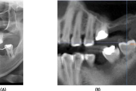 Fig.  4. (A) Panoramic view (first visit). (B) Pre-operative CT panoramic view. (C) Pre-operative CT  coronal view