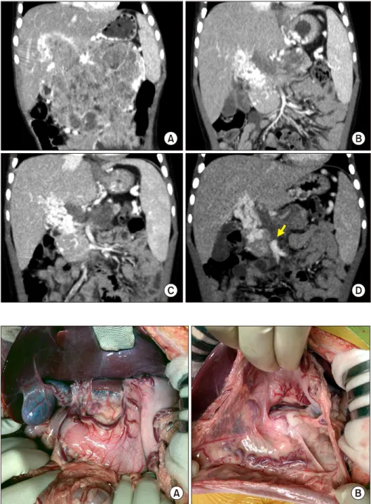 Fig. 1. Pretransplant computed  tomography findings. The size  of pancreatoblastoma was  gradu-ally reduced according to the  neoadjuvant chemotherapy,  sh-owing serial size changes as  fol-lows: at diagnosis (A), five  mon-ths before transplantation, (B) 