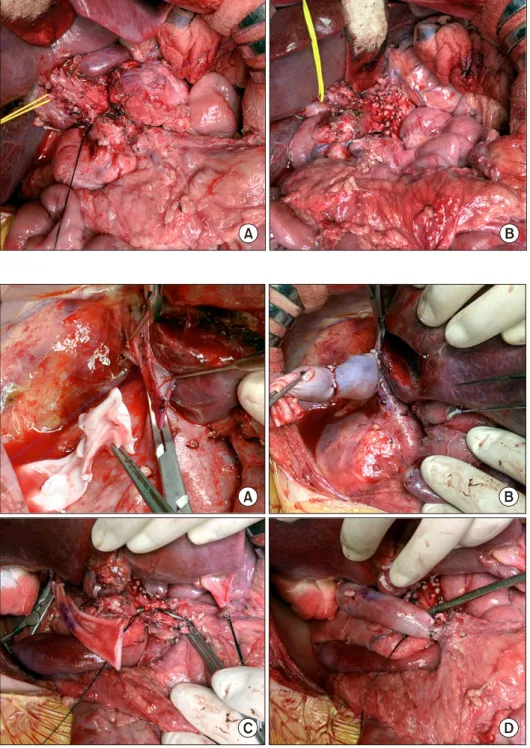 Fig. 3. Intraoperative photogra- photogra-phs of spleen-preserving distal  pancreatectomy