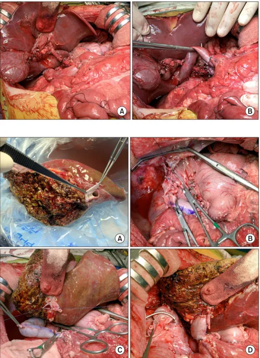Fig. 5. Intraoperative photogra- photogra-phs of spleen-preserving  reg-ional total pancreatectomy