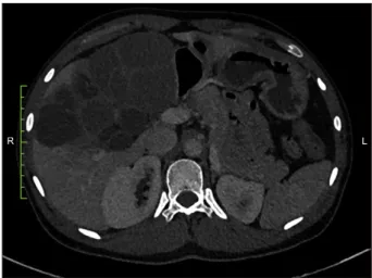 Fig. 2. (A) Resected gross speci- speci-men of ~18×16×9 cm with  bosselated surface containing  multiple cysts