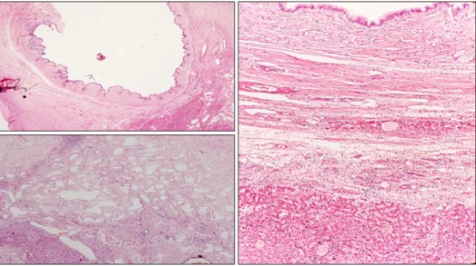 Fig. 3. Histopathology report: multiloculated cyst contains variable size of cystic spaces lined by mucinous epithelium, at places  it is replaced by macrophages sheets