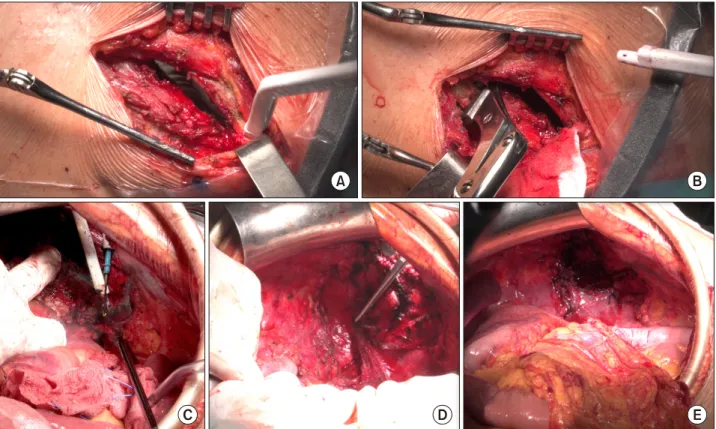 Fig. 4. (A, B) Left thoracotomy was performed and the 9 th  and the 10 th  ribs were transected