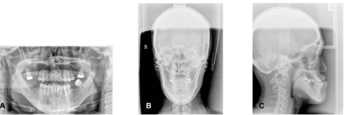 Fig. 1. Initial Radiograph. (A) Initial panoramic radiograph. (B) Initial posterioanterior cephalography