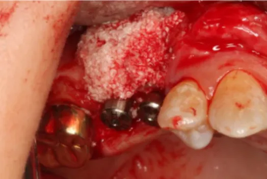 Fig. 4. Implants (Osstem TS III SA) were installed at #15, 16 area. Ridge expansion and bone graft  (Biocera) were performed.