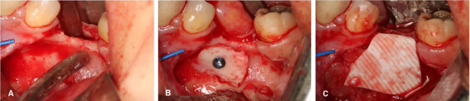 Fig. 7. Horizontal ridge augmentation was perfomed. (A) Narrow ridge was observed after flap elevation