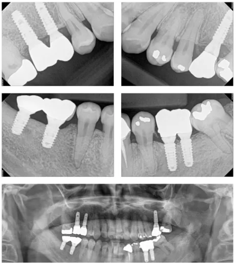 Fig. 10. Periapical and panoramic radiograph 5 years after implant prosthetic function.