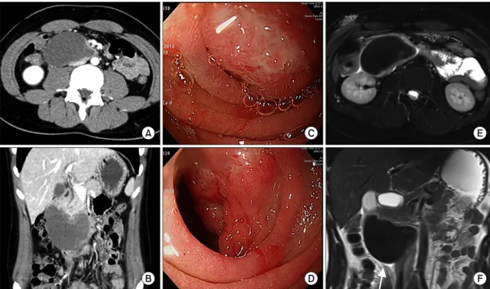Fig. 1. (A), (B) are axial and coronal view of abdominopelvic CT, showing intramural hematoma of duodenum 2nd and 3rd  portion